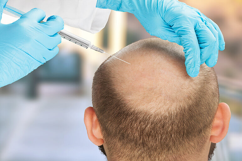 Procedimento Injetável direto no couro cabeludo