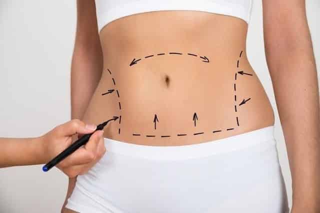 Abdominoplastia em Guarulhos