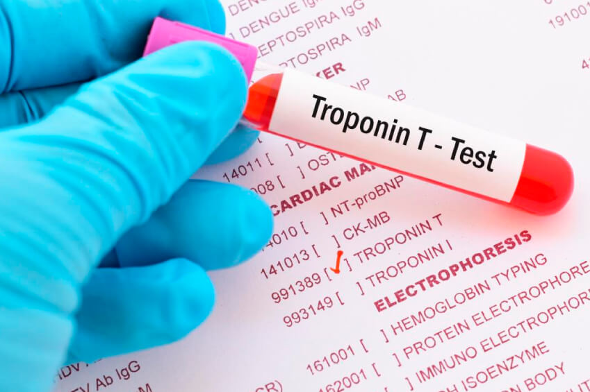 Teste Rápido de Troponina I em Guarulhos Teste Rápido de Troponina I em Guarulhos