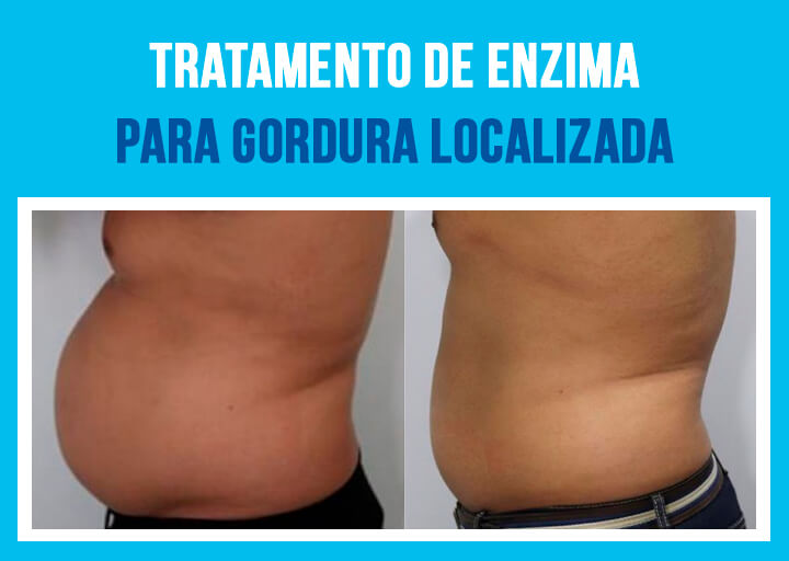 Tratamento com Enzimas para Gordura Localizada em Guarulhos