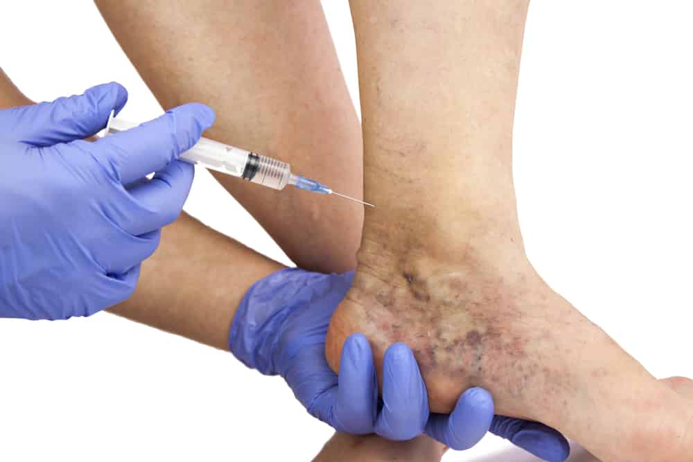 Escleroterapia com Glicose em Guarulhos Escleroterapia com Glicose em Guarulhos